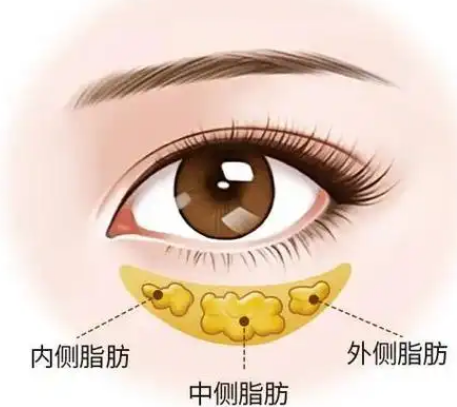 去眼袋手术