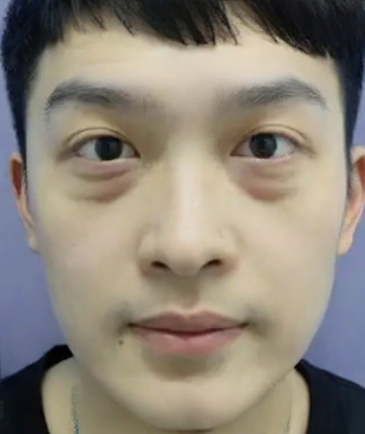去眼袋手术