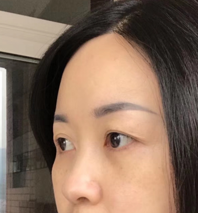 去眼袋手术