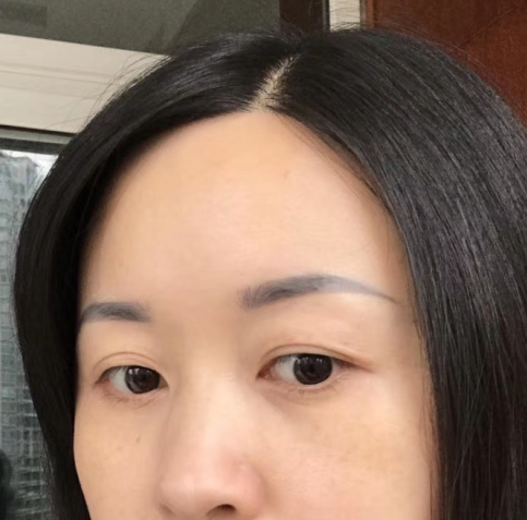 去眼袋手术