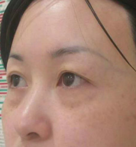 去眼袋手术