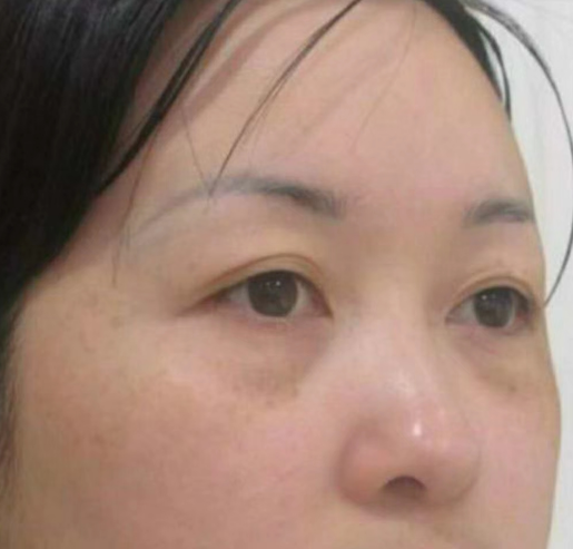 去眼袋手术