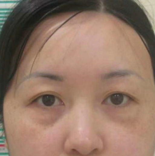 去眼袋手术