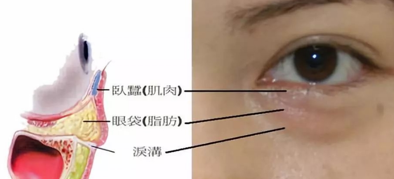 去眼袋手术