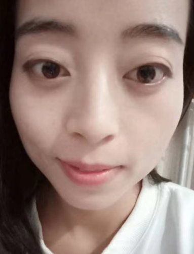 去眼袋手术