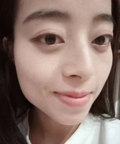 去眼袋手术