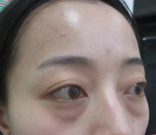 去眼袋手术