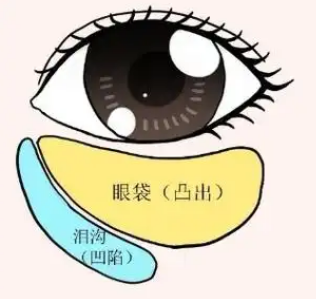 去眼袋手术