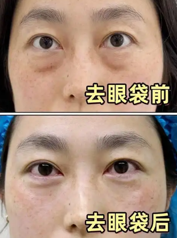 去眼袋手术