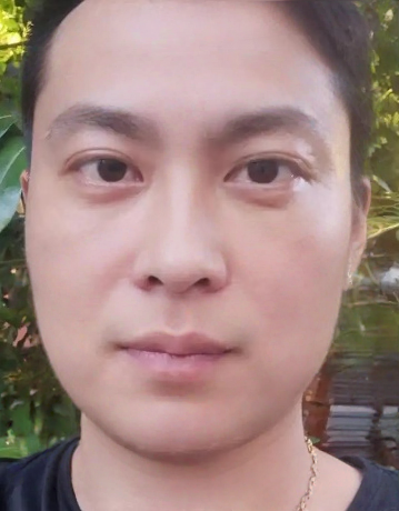 去眼袋手术