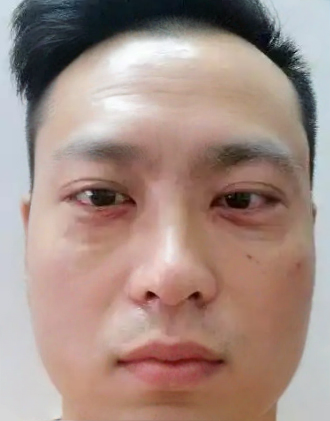 去眼袋手术