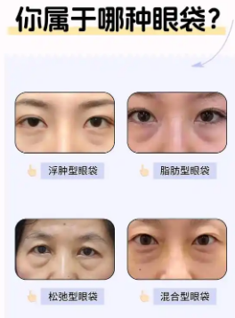 去眼袋手术