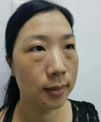 去眼袋手术
