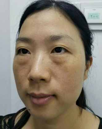 去眼袋手术