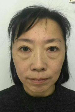 去眼袋手术