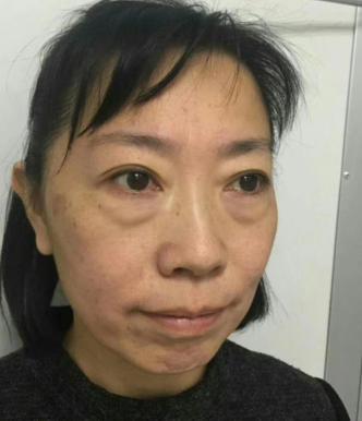 去眼袋手术