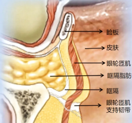 去眼袋手术