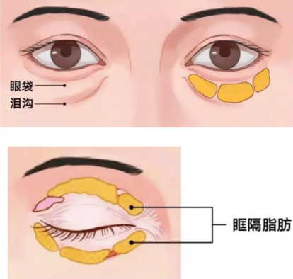 去眼袋手术