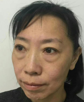 去眼袋手术