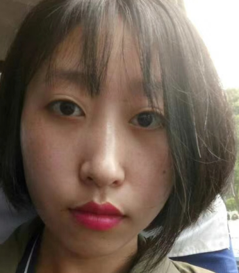 去眼袋手术