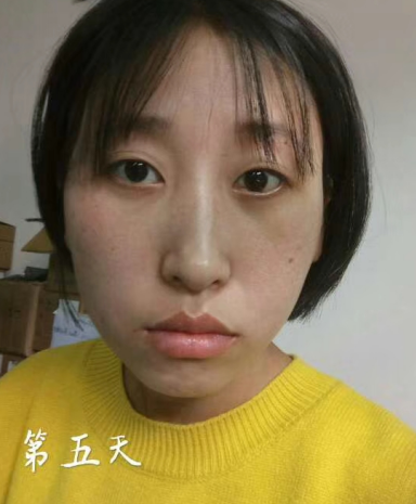 去眼袋手术