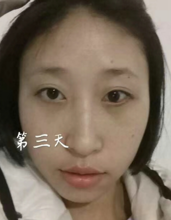 去眼袋手术