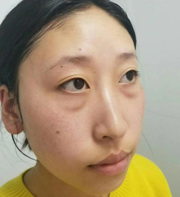 去眼袋手术
