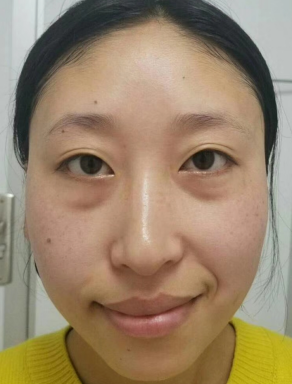 去眼袋手术