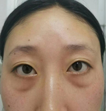去眼袋手术