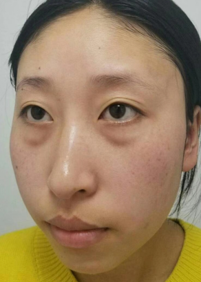 去眼袋手术