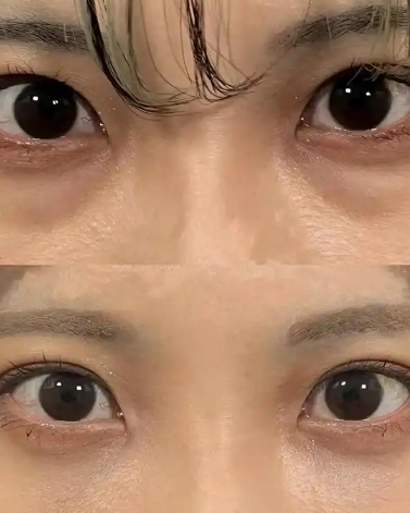 去眼袋手术