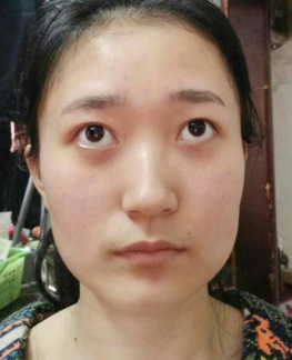 去眼袋手术