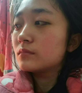 去眼袋手术