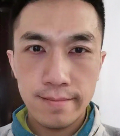去眼袋手术