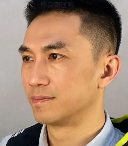 去眼袋手术