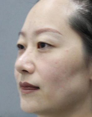 去眼袋手术