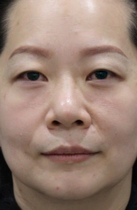 去眼袋手术