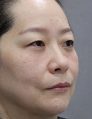 去眼袋手术