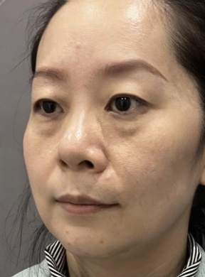 去眼袋手术