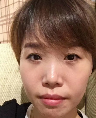 去眼袋手术