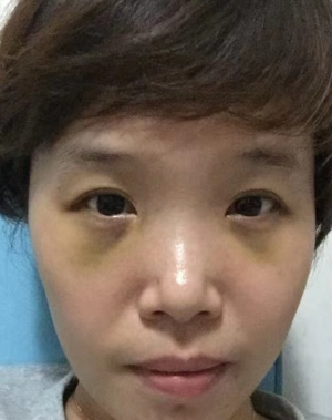去眼袋手术