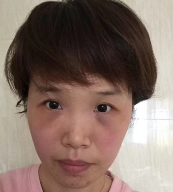 去眼袋手术