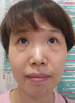 去眼袋手术