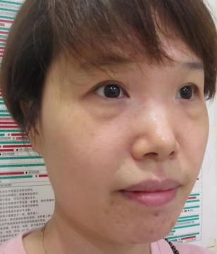 去眼袋手术
