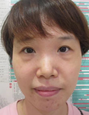 去眼袋手术