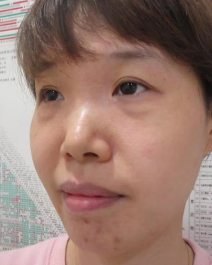 去眼袋手术
