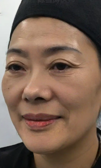 去眼袋手术