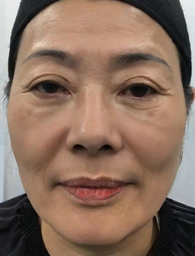 去眼袋手术