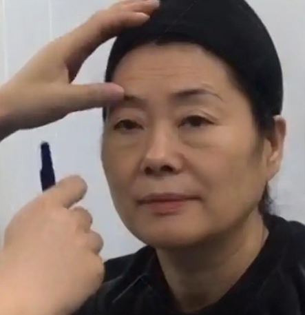 去眼袋手术
