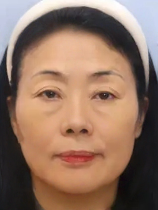 去眼袋手术